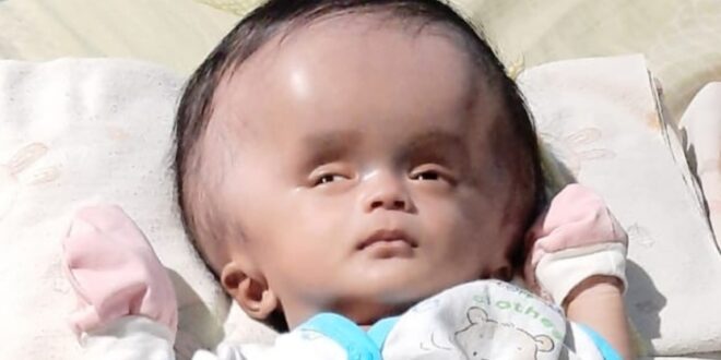 LensaHukum.co.id - Screenshot 20211130 234946 Samsung Internet 660x330 - Miris Bayi Hidrosefalus Butuh Bantuan Dan Perhatin Dinas Terkait